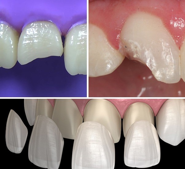 Tooth preparation for dental veneers