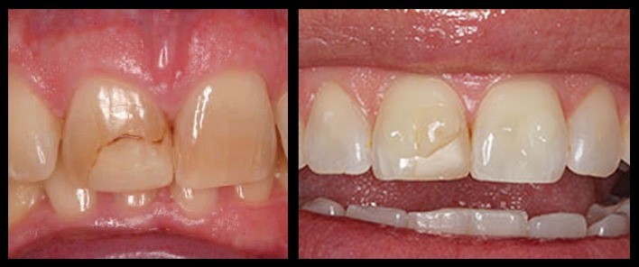 Concerns after the procedure after dental veneers