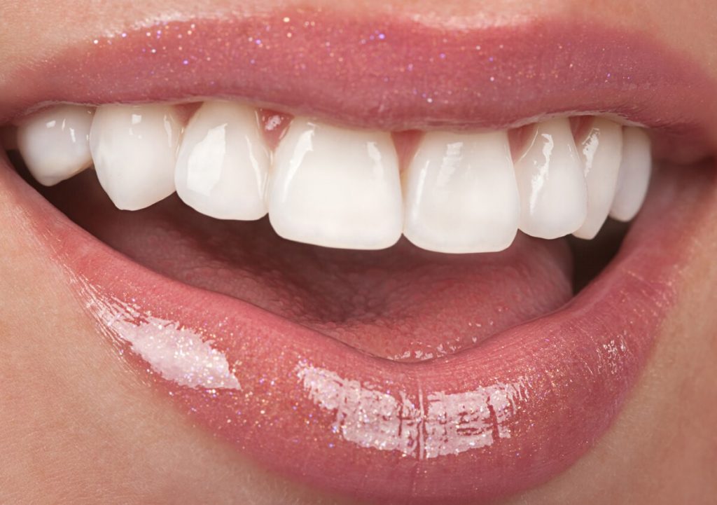 A smiling image after placement of veneers in dental clinic