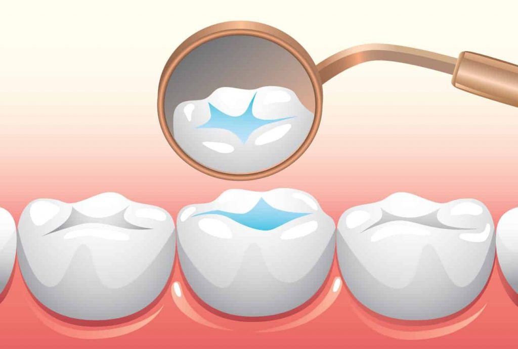 Pit and Fissure Sealants in Pediatric Dentistry: A Comprehensive Guide 