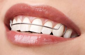 Types of Retainers in Dentistry: Removable Vs Permanent