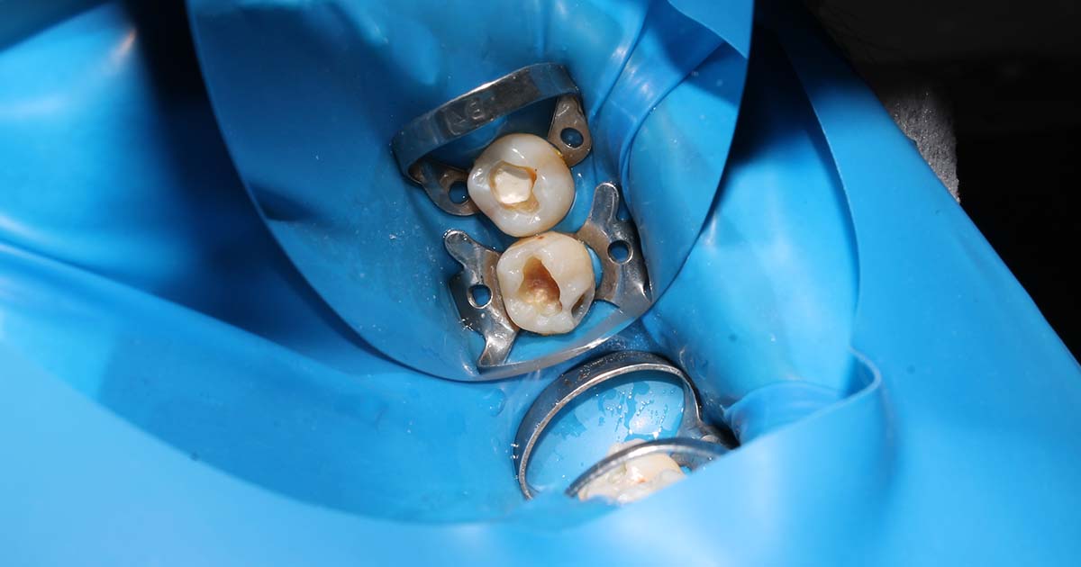 Dental Rubber Dam Guide: Improve Isolation, Safety, and Visibility