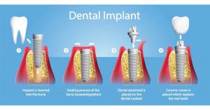 Dental Implant Instruments: The Key to Precision and Success