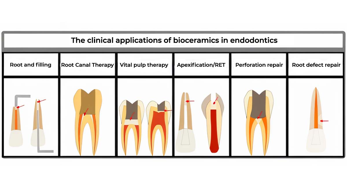 Emerging Bioceramic Materials in Endodontics: Benefits, Limitations, and Clinical Applications 