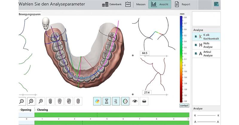 Digital Occlusion Analysis: The Future of Bite Correction 