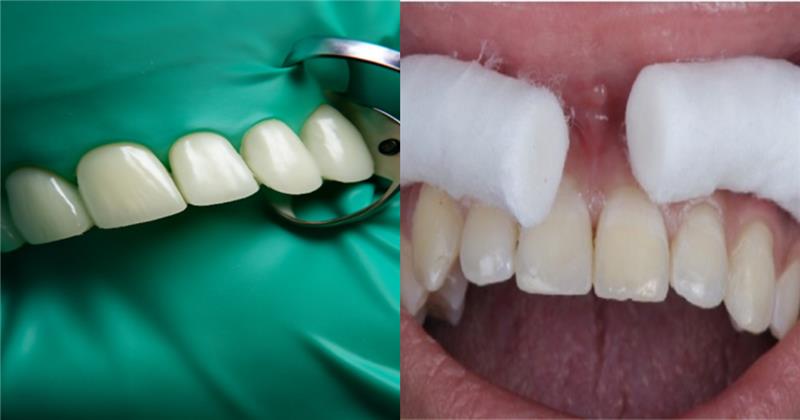 Composite Failures: Causes, Prevention &amp; Clinical Solutions