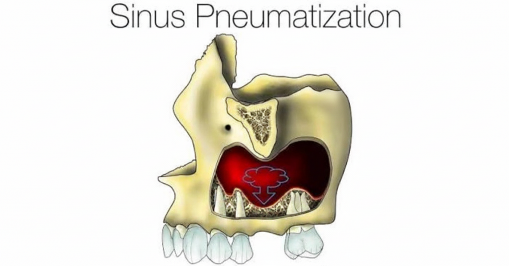 Crestal vs. Lateral Sinus Lift: When to Use Which Technique?