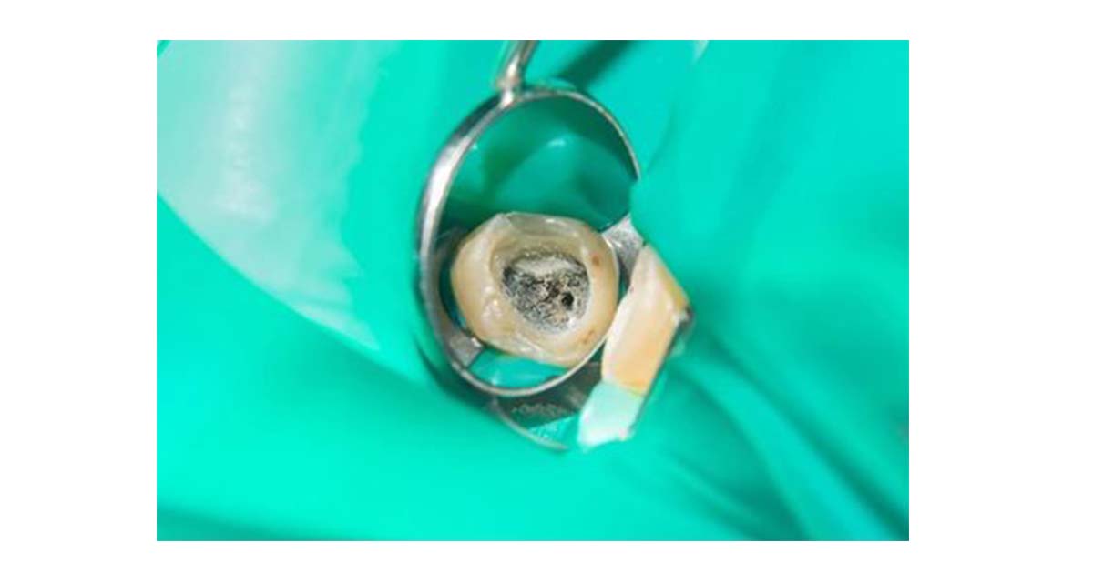 Incomplete removal of caries