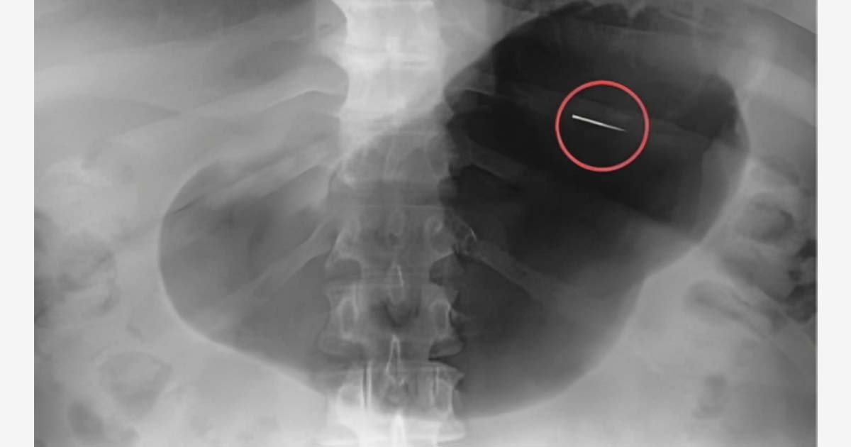 Aspiration or ingestion of endodontic instruments