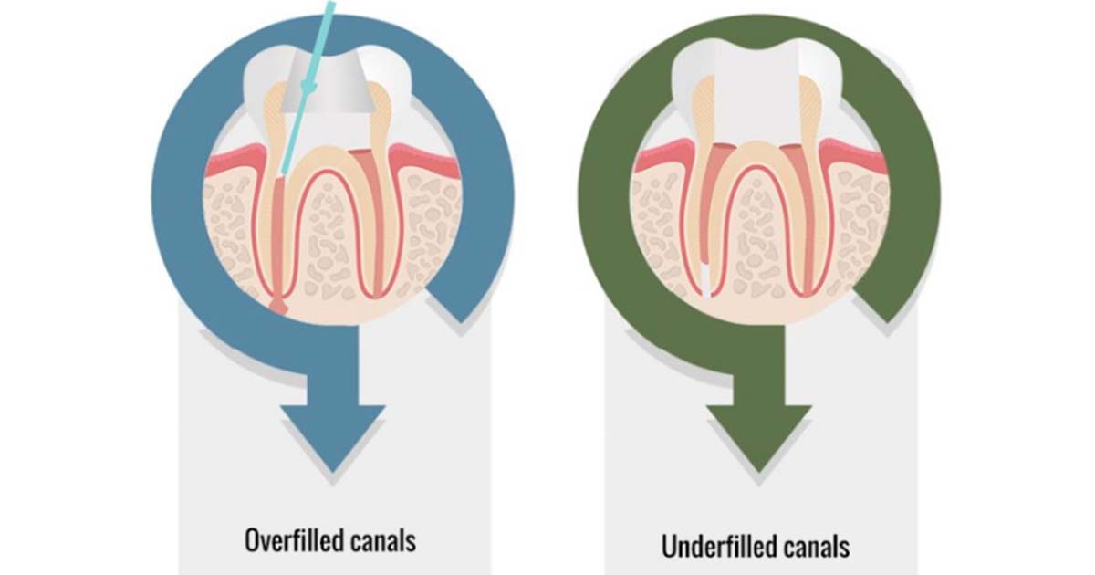 Underfilling and Overfilling of gutta-percha