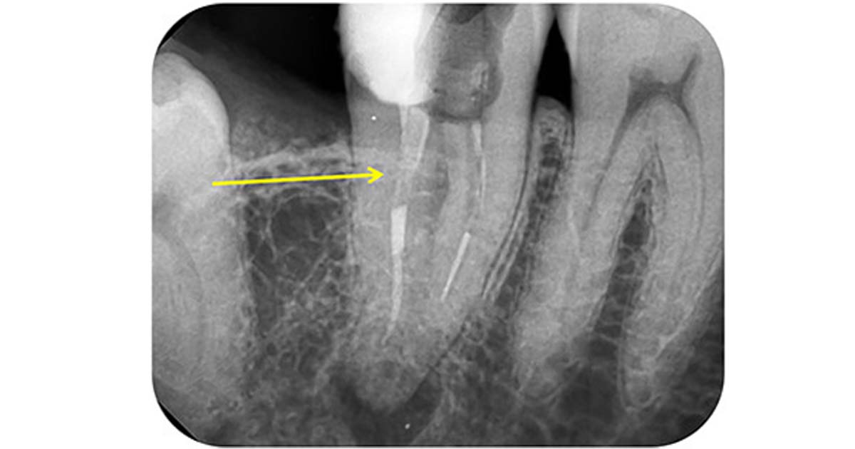 Obstruction by previous obturating materials