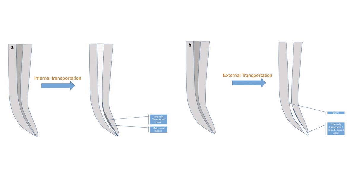 Deviation from normal canal anatomy