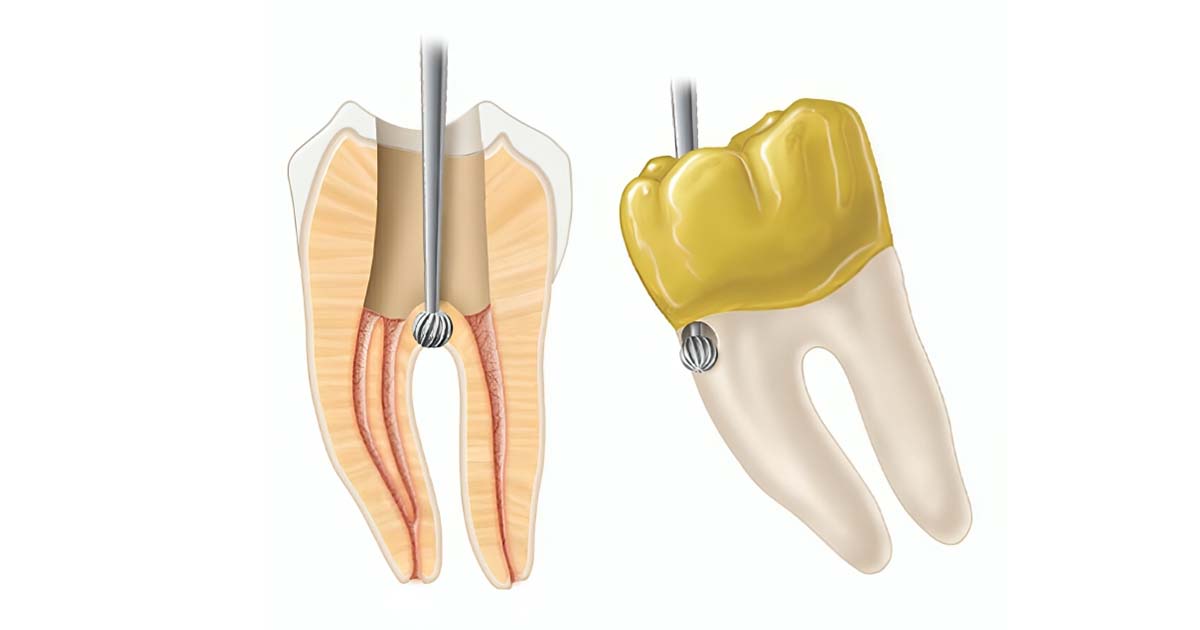 Iatrogenic perforations