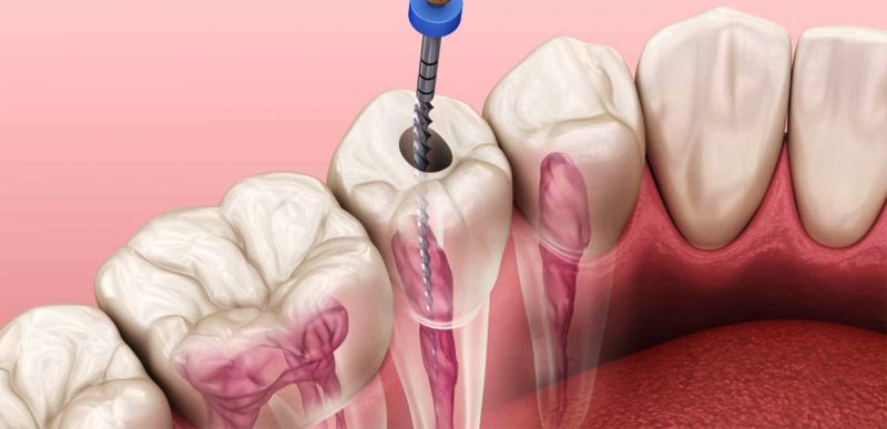 Common Mistakes in a Root Canal Treatment
