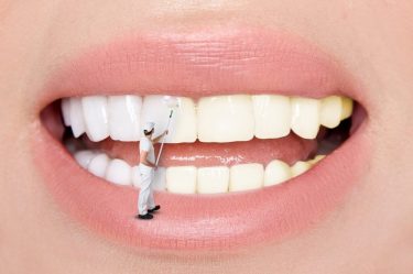 dental veneers and composites blog featured image