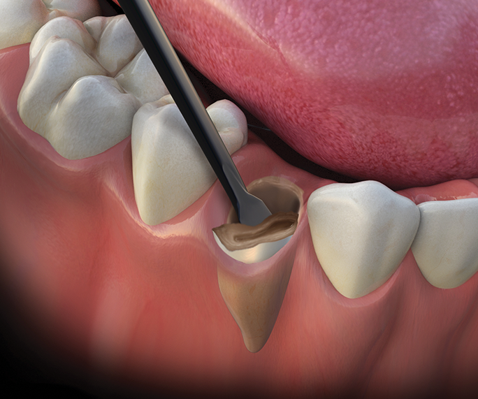 Atraumatic Extraction Procedure: A Comprehensive Guide to Minimally Invasive Tooth Removal