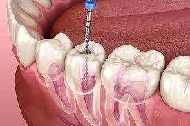 Manual vs Rotary Endodontics: A Comprehensive Comparison for Successful Root Canal Treatment