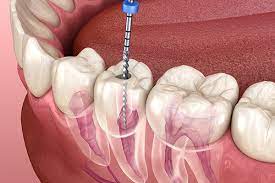 Blog-Manual-vs-rotary-endodontics