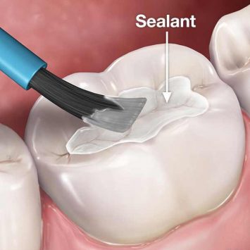 Significance of Pit & Fissure Sealants in Paediatric Dentistry: A Comprehensive Guide for Dental Professionals