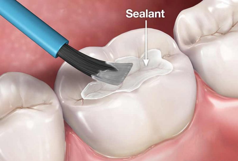 Pit and Fissure Sealants in Pediatric Dentistry: A Comprehensive Guide 2025