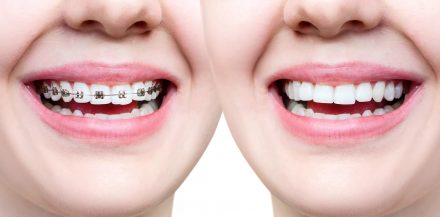 Fixed Orthodontics vs. Clear Aligners: A Comprehensive Comparison for Dental Professionals