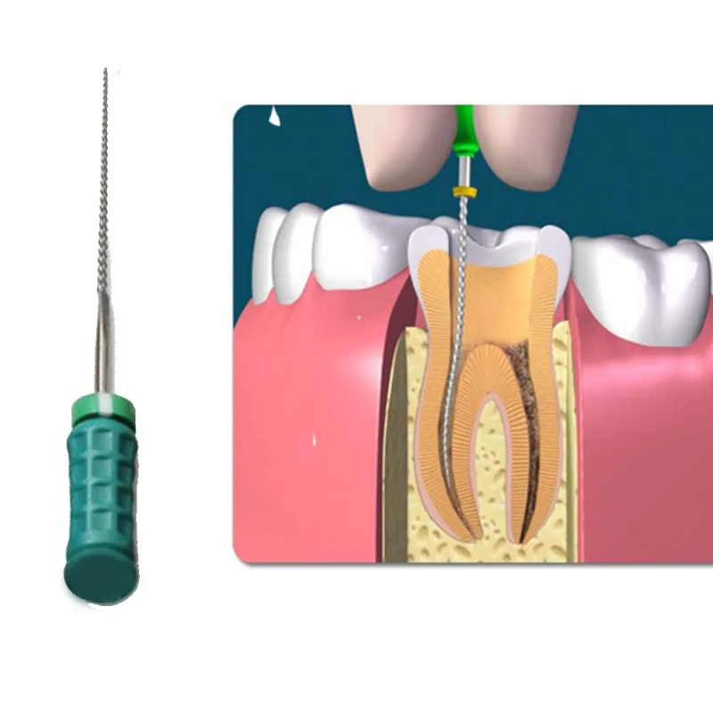 K-files in Endodontics – Choosing the Right K-Files for Success