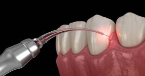 Benefits of Laser Dentistry