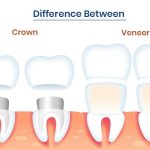 Veneers vs Crowns: Which Will Perfect Your Smile