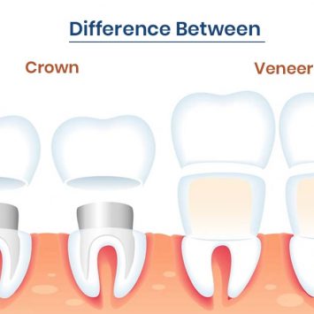 Veneers vs Crowns: What’s the Difference?