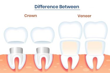 Veneers vs Crowns: Which Will Perfect Your Smile