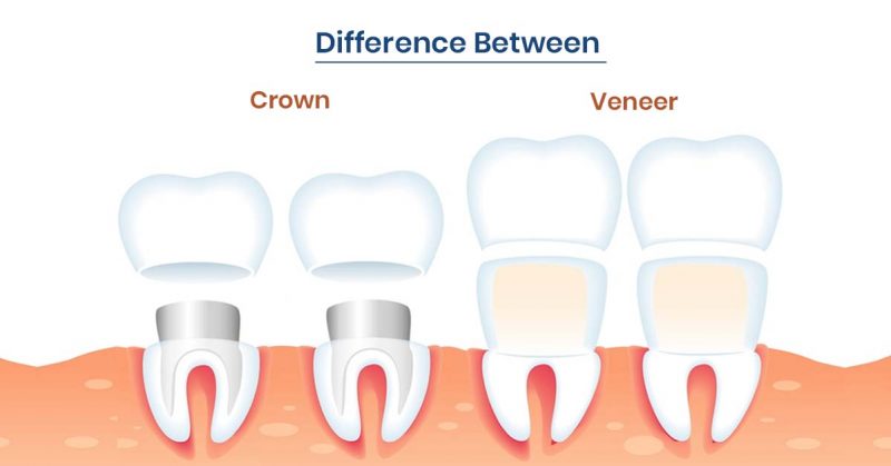 Veneers vs Crowns: What’s the Difference?