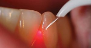 Laser Dental Procedure