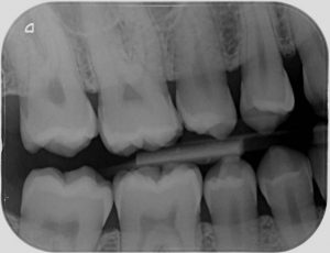 Bitewing X-rays