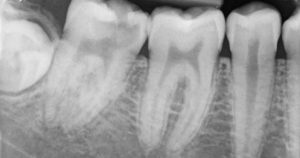 Periapical X-rays