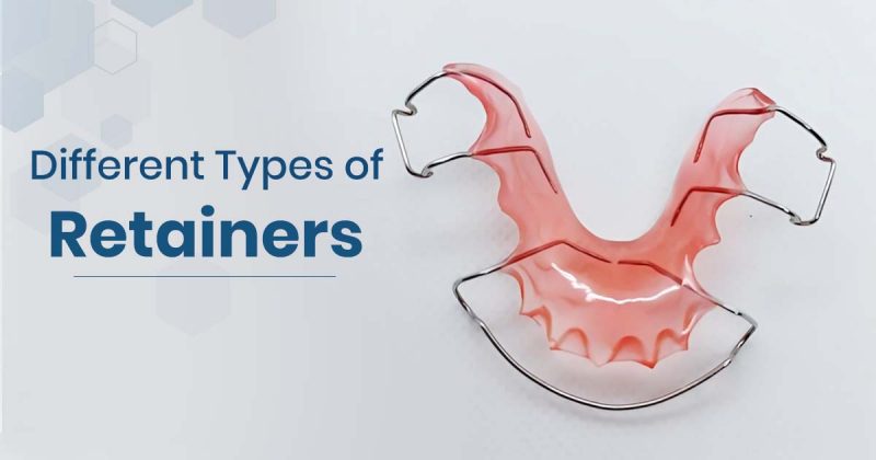 Different Types of Retainers