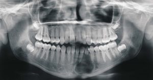 Panoramic X-rays