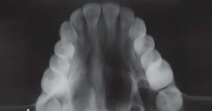 Occlusal X-rays