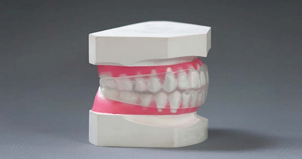 Different Types of Retainers Dentalkart Blogs Section of Dentalkart