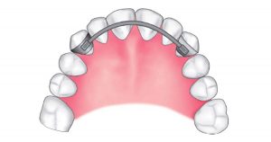 Banded canine-to-canine retainer 