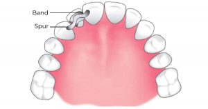 Band and spur retainers: