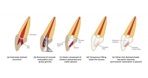 Intracoronal bleaching- WALKING BLEACH Teeth Whitening