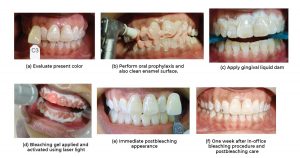 Teeth Whitening : Extracoronal bleaching- IN–OFFICE VITAL BLEACH