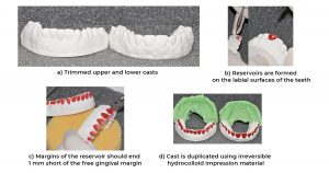 Teeth Whitening: Extracoronal bleaching -AT – HOME BLEACHING 