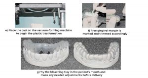 Extracoronal bleaching -AT – HOME BLEACHING 2 