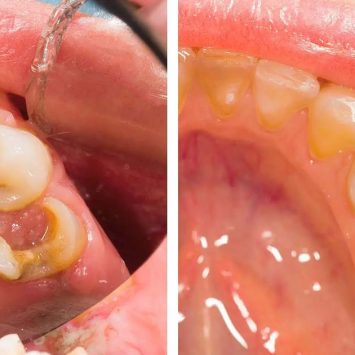 Types of Dental Composite in Dentistry