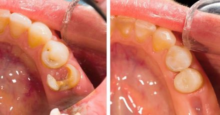 Types of Dental Composite in Dentistry