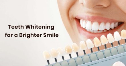 Teeth Whitening : Types, Procedure and Technique