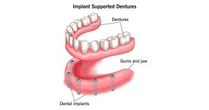 implant supported denture