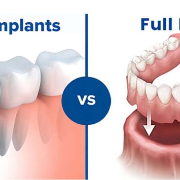 Dentures vs Implants – What to choose, Advantages and Disadvantages