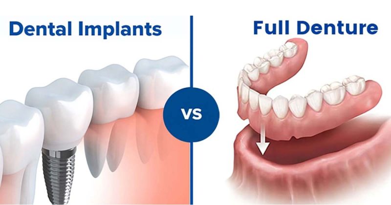 Dentures vs Implants – What to choose, Advantages and Disadvantages